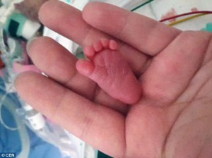 Chân Emilia chỉ bằng ngón tay của người lớn.