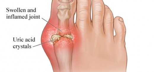 gout big toe 520x245